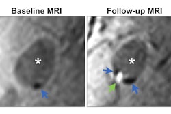 Demonstration of colocalization of pre-existing calcification and incident intraplaque hemorrhage (IPH) in the same plaque. Axial cross sections of the same plaque at the same arterial location on a scan obtained with a T1-weighted gradient-echo noncontrast MRI sequence in a 70-year-old female participant who was free of coronary heart disease and stroke before follow-up MRI. Baseline (left) and follow-up (right) MRI examinations. The blue arrows highlight calcification in a hypointense signal area, while the green arrow indicates IPH as a hyperintense signal. The asterisks mark the lumen of the carotid artery.