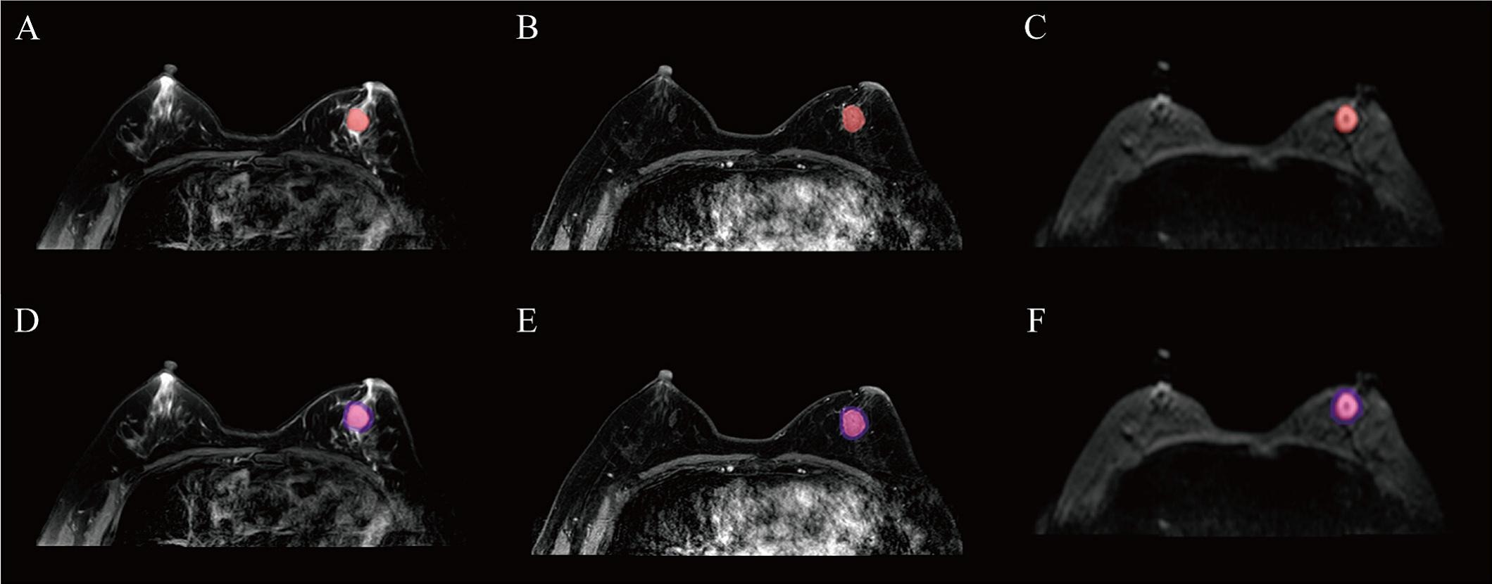 The results depict tumor segmentation. an example of HER2 positive breast cancer is shown: (A), (B), and (C) represent the segmentation results of the entire tumor region on the T2WI, DCE-MRI, and DWI sequences, respectively; (D), (E), And (F) show the segmentation results of the intratumoral region combined with 3 mm peritumoral area on the T2WI, DCE-MRI, and DWI sequences, respectively.