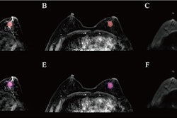 The results depict tumor segmentation. an example of HER2 positive breast cancer is shown: (A), (B), and (C) represent the segmentation results of the entire tumor region on the T2WI, DCE-MRI, and DWI sequences, respectively; (D), (E), And (F) show the segmentation results of the intratumoral region combined with 3 mm peritumoral area on the T2WI, DCE-MRI, and DWI sequences, respectively.