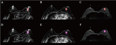 The results depict tumor segmentation. an example of HER2 positive breast cancer is shown: (A), (B), and (C) represent the segmentation results of the entire tumor region on the T2WI, DCE-MRI, and DWI sequences, respectively; (D), (E), And (F) show the segmentation results of the intratumoral region combined with 3 mm peritumoral area on the T2WI, DCE-MRI, and DWI sequences, respectively.