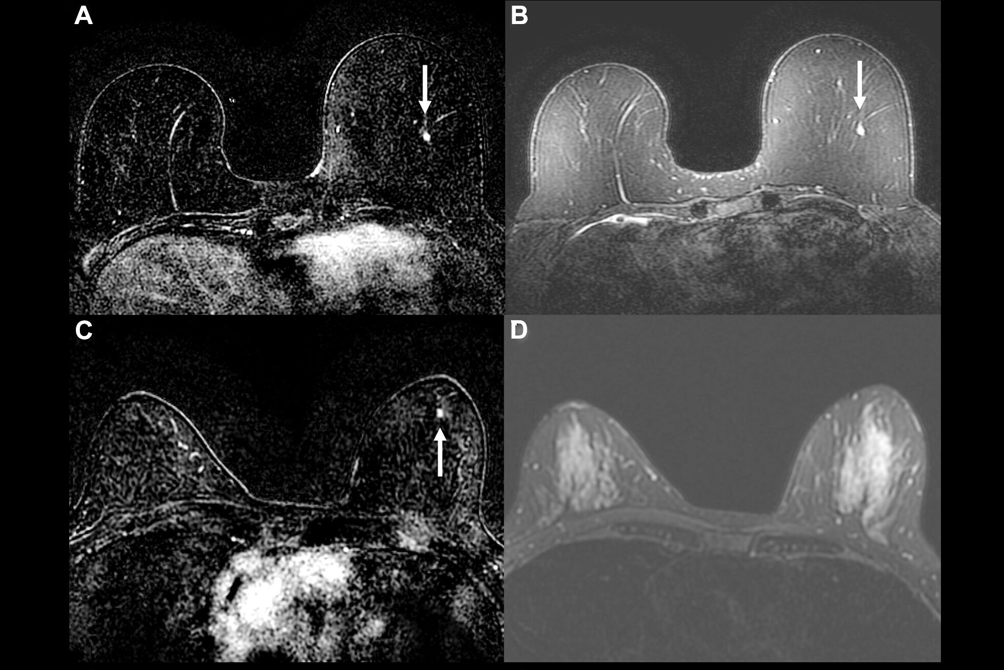 2025 06 03 Rsna Ai Breast Mri Triage Thumbnail
