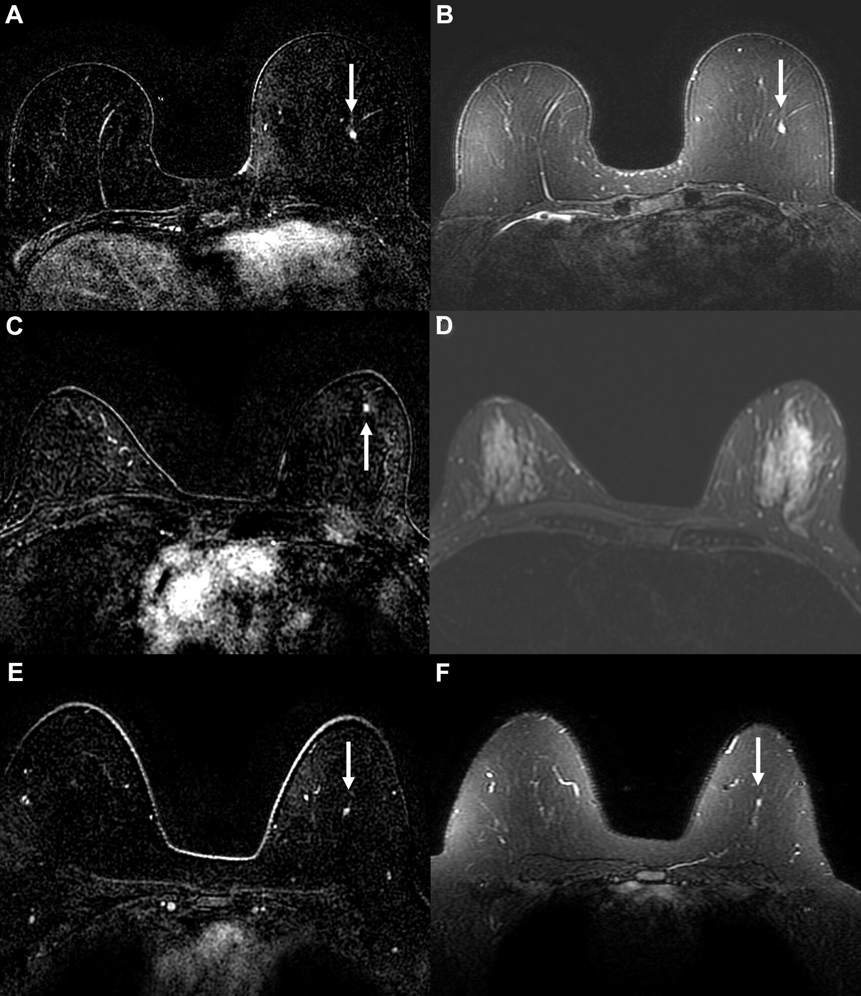 AI-directed breast MRI scanning may lead to shorter scan