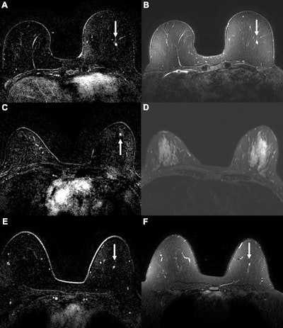 Example cancer examinations where the AI suspicion score prompted triage to abbreviated breast MRI, but readers still assessed the abbreviated MRI exam as suspicious. Axial (A) dynamic contrast-enhanced (DCE) and (B) fat-saturated T2-weighted MRI scans in a 58-year-old woman with a 0.3-cm enhancing focus (arrow) in the left breast. The AI tool generated a suspicion score of 0.68 (43rd percentile of suspicion score), prompting triage at the 50% threshold. For abbreviated MRI, readers gave the examination a suspicious assessment, but for the full MRI protocol, readers missed the suspicious finding, possibly owing to its T2 hyperintensity. The original radiologist also gave a benign assessment, but cancer was diagnosed six months later via mammography, with calcifications indicating ductal carcinoma in situ. Axial (C) DCE and (D) fat-saturated T2-weighted MRI scans in a 51-year-old woman with a 0.3-cm enhancing focus (arrow in C) in the left breast. The AI tool generated a suspicion score of 0.42 (17th percentile), prompting triage at the 50% threshold. For both abbreviated and full MRI, readers gave the examination a suspicious assessment, although the original radiologist report gave a benign assessment. Cancer was diagnosed six months later via mammography. Biopsied calcifications indicated ductal carcinoma in situ. Axial (E) DCE and (F) fat-saturated T2-weighted MRI scans in a 49-year-old woman with a 0.4-cm enhancing focus (arrow) in the left breast. The AI tool generated a suspicion score of 0.62 (37th percentile), prompting triage at the 50% threshold. The lesion was missed by readers at both abbreviated and full MRI. The patient was diagnosed with invasive ductal carcinoma six months after an abnormal contrast-enhanced mammogram.