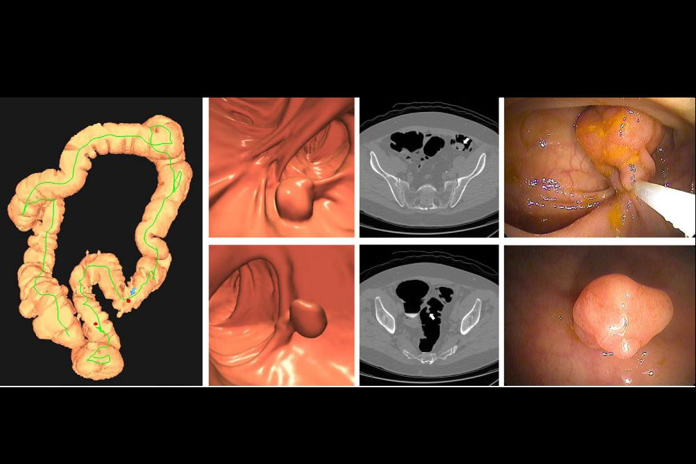 2025 06 10 Radiology Ct Colonography Thumbnail