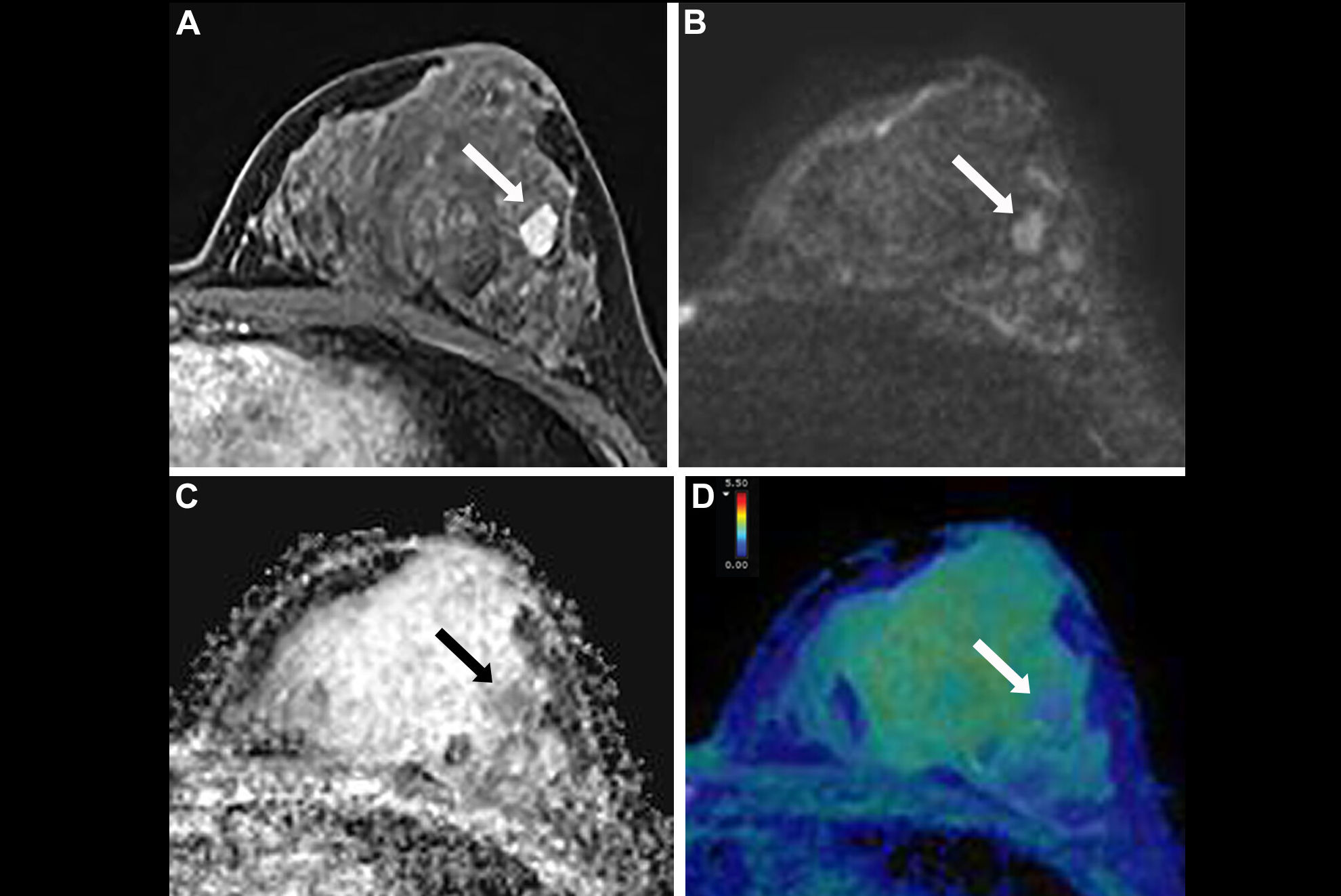 2025 06 10 Radiology Dwi Mri Breast Thumbnail