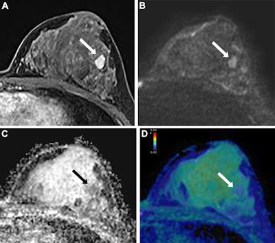 Images show ADC measurements for a BI-RADS 4 lesion in the left contralateral breast of a 49-year-old woman who underwent preoperative MRI for right invasive ductal carcinoma. (A) Axial dynamic contrast-enhanced MRI scan reveals a 1-cm oval, circumscribed, homogeneous mass (arrow) in the left breast. (B-D) At axial diffusion-weighted imaging (DWI; b value = 1,200 sec/mm2), the lesion (arrow) has high signal intensity (B), with an ADC of 1.2 × 10−3 mm2/sec, and is shown on the ADC map calculated using b values of 0 and 800 sec/mm2 (C) and fused DWI and ADC image (D). Biopsy revealed a benign fibroadenoma.