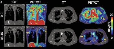 Representative coronal (left) and transverse (right) CT and C-11-PABA PET/CT images from a 33-year-old female with cystic fibrosis and confirmed M. abscessus infection in a 45-minute dynamic PET scan after an intravenous injection of 518 MBq of C-11-PABA. In the first nine minutes of the scan C-11-PABA got distributed systemically, followed by rapid clearance via heptic and renal excretion, showing accumulation of C-11-PABA only inside the affected lesion in the last 10 minutes. Not all lesions visualized on CT were PET avid, suggesting that some lesions may be sterile or had very low bacterial burden. The y axis shows time in minutes. Image and caption courtesy of the SNMMI and Yuderleys Masias-Leon, MD.