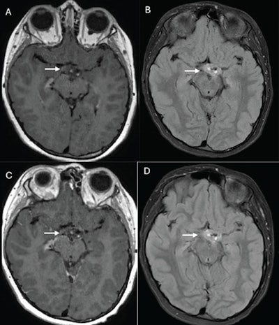 10-year-old boy who underwent brain MRI examinations due to optic tract glioma (A, B) Axial postcontrast 3D T1-weighted fast-spin echo (A) and fluid-attenuated inversion-recovery image or sequence (FLAIR) (B) images from examination performed using gadoterate meglumine. (C, D) Axial postcontrast 3D T1-weighted gradient-recalled echo (C) and FLAIR (D) images from examination performed using gadopiclenol. Images show expansile lesion centered in left optic tract, with punctate enhancement medially and posteriorly (arrow, A-D). Readers 1 and 2 assigned score for border delineation on 3D T1-weighted fast-spin echo of -2 and -1; for border delineation on FLAIR of 0 and 0; for contrast enhancement on 3D T1-weighted fast-spin echo of -2 and -2; for contrast enhancement on FLAIR of 0 and 1; for internal morphology on 3D T1-weighted fast-spin echo of -1 and -2; and for internal morphology on FLAIR of 0 and 0. Negative values indicate preference for gadopiclenol-enhanced examination, whereas positive values indicate preference for gadoterate meglumine-enhanced examination. Image and caption courtesy of the AJR.