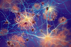 Brain Amyloid Plaque Neuron