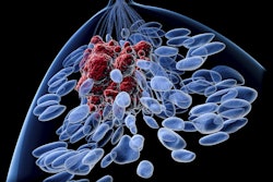 Breast Cancer