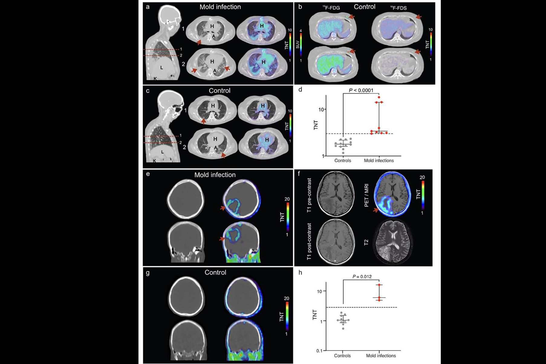 F18 Fds Pet In Human Snmmi 2025 Johns Hopkins Research Thumbnail