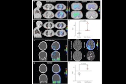 F18 Fds Pet In Human Snmmi 2025 Johns Hopkins Research Thumbnail