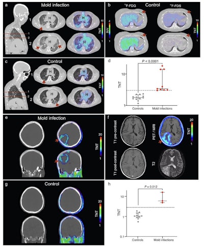 Representative F-18 FDS PET/CT images of patients with (a) pulmonary aspergillosis (n = 3), (b) control patient with breast cancer (n = 1). In this patient, F-18 FDG PET shows the cancer lesion (arrow) which is not visualized on the F-18 FDS PET. (c) Control patients with interstitial lung disease (n = 4). (d) Quantification of F-18 FDS PET as target-to-nontarget (TNT) ratio; n = 3 volume of interest per patient. Representative F-18 FDS PET/CT images of a patient with (e) invasive cerebral aspergillosis and (g) uninfected control. (f) Transverse sections showing MRI and PET/MRI from a patient with invasive cerebral aspergillosis. (h) F-18 FDS PET quantification TNT ratio in brain derived from two patients with invasive cerebral mold infections, and five control patients without cerebral pathology with n = 2 VOIs per patient (patient 4 with mold infection has 1 VOI only). Lesions are highlighted with arrows.