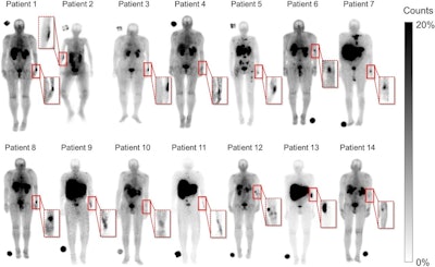 Planar gamma camera images (conjugate view geometric mean) of 14 patients with identified extravasations (highlighted in red dashed box) acquired using Philips XCT (patients 1-4) and Siemens Symbia 1 and 2 SPECT/CT systems (patients 5-14). All patients, except patient 2, had infusion in left arm. Gray scale was narrowed to 20% to enhance visualization of extravasations.