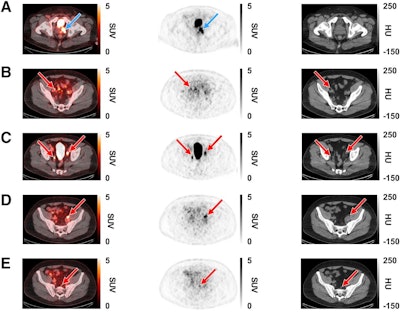 Representative F-18 CTT1057 PET/CT scan case showing true-positive lesions in primary tumor (PT) and pelvic lymph nodes (PLNs) metastases in 63-y-old patient (PT clinical stage 3; Gleason score, 9 [4 + 5]; PSA, 14.2 ng/mL). Axial slices (left to right) show fused PET/CT scan, PET scan, and CT scan. (A) True-positive lesions in left prostate gland (SUVmax, 14; blue arrows). (B–E) True-positive lesions were seen in several PLNs (red arrows). (B) Right external iliac (SUVmax, 4.7). (C) Right internal iliac (SUVmax, 6.9) and left external iliac (SUVmax, 11.4). (D) Left external iliac (SUVmax, 10.2). (E) Presacral (SUVmax, 3.6). HU = Hounsfield units.
