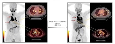 A 56-year-old woman with disease progression after surgery received Lu-177 FAPI-RGD at 2.2 GBq/cycle. Baseline Ga-68 FAPI-RGD PET/CT revealed intense Lu-177 FAPI-RGD uptake in most metastatic lesions including lymph node and lung modules (left, arrows and square box). After two treatment cycles, a restaging Ga-68 FAPI-RGD-PET/CT scan revealed a significant reduction in tumor size in most of the metastatic lesions. Furthermore, most of the lesions in the lungs have disappeared (right, arrows and square box).