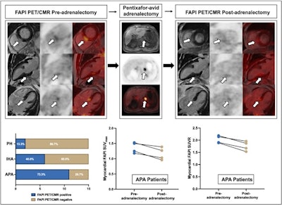 Reversible heart damage in a primary aldosteronism patient: Pre- versus post adrenalectomy Ga-68 FAPI-04 PET/Cardiac MRI in an APA patient, showing decreased uptake in the basal inferoseptal segment.