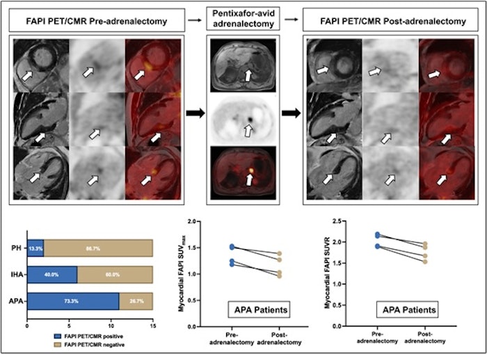 Reversible Heart Damage In Primary Aldosteronism Patient
