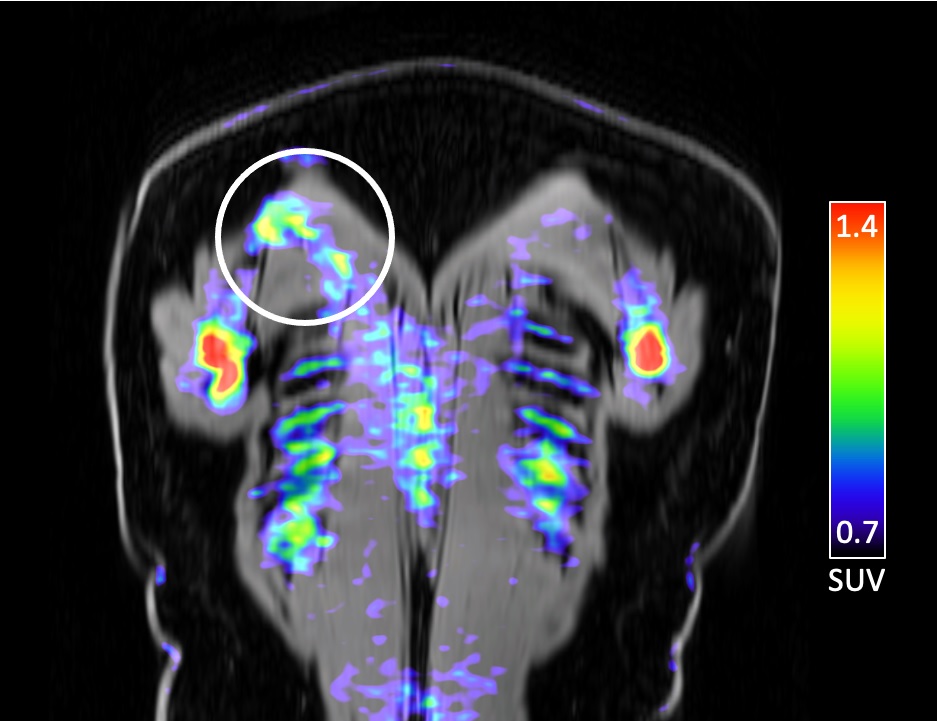 Coronal fused FDG-PET/MRI image of a patient with right upper back pain demonstrates asymetric uptake in the right trapezius muscle without abnormality on MRI to suggest edema or denervation injury. Trigger point lidocaine injection of the area based on PET/MRI findings resulted in complete relief of symptoms (pain score reduced to 0 from a baseline of 6).