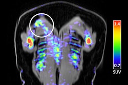Coronal fused FDG-PET/MRI image of a patient with right upper back pain demonstrates asymetric uptake in the right trapezius muscle without abnormality on MRI to suggest edema or denervation injury. Trigger point lidocaine injection of the area based on PET/MRI findings resulted in complete relief of symptoms (pain score reduced to 0 from a baseline of 6).