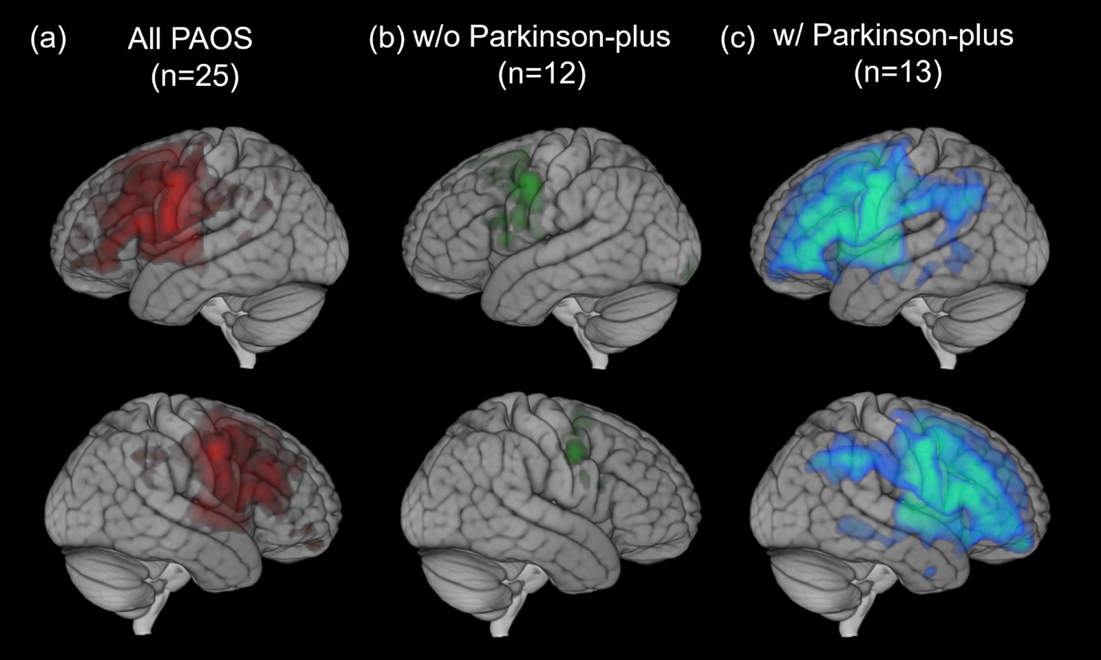 Images depict brain regions where PAOS had greater neuroinflammation than that seen in healthy individuals.