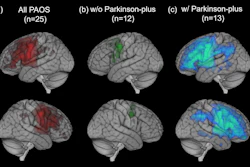 Images depict brain regions where PAOS had greater neuroinflammation than that seen in healthy individuals.