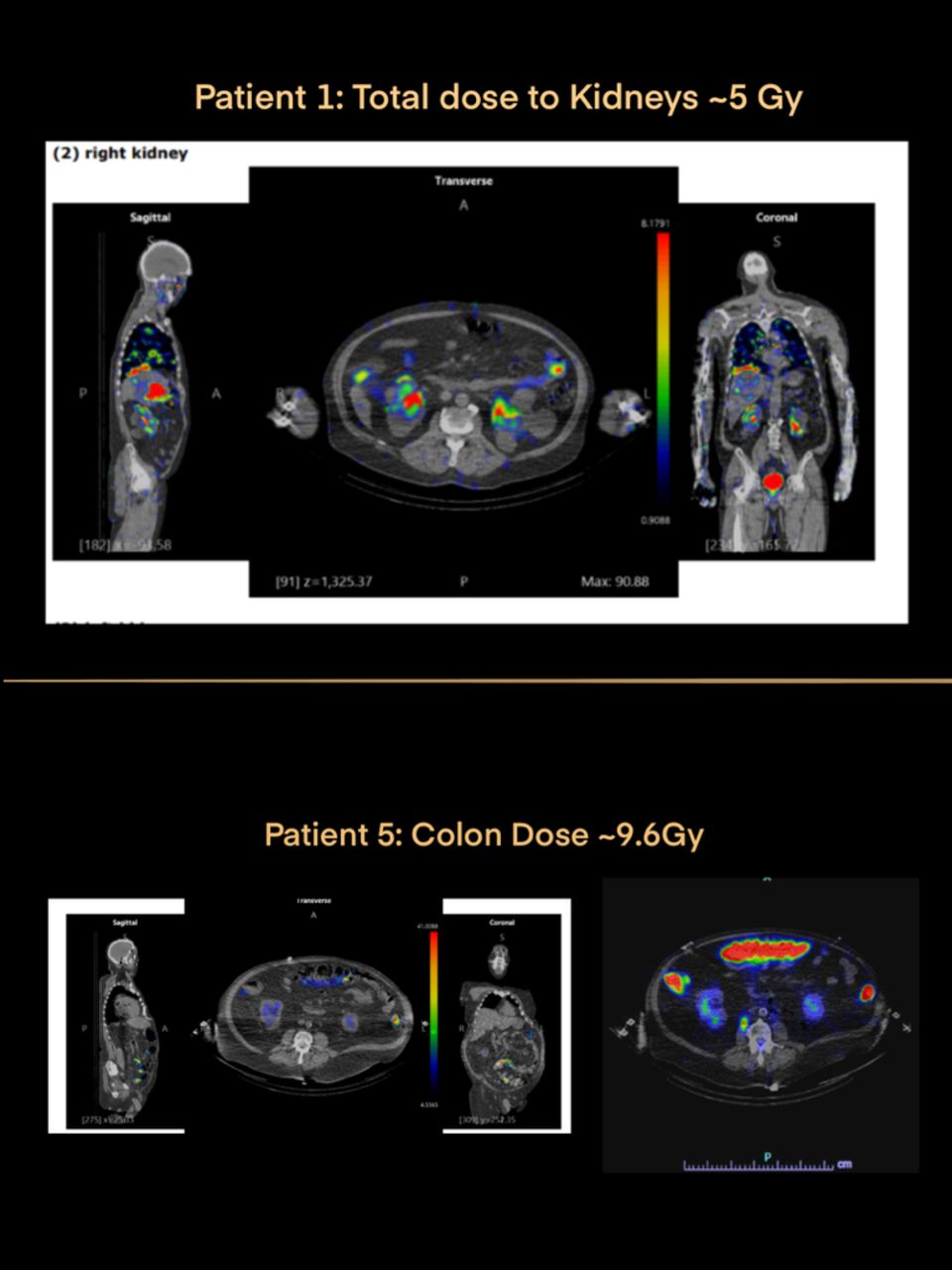 Top image displays a patient assessed for acute renal failure following third Lutathera administration where 3D dosimetry showed an average-per-administration kidney absorbed dose of 5 Gray, with total course of therapy being well under toxicity limits. Bottom image displays a patient&rsquo;s absorbed dose to the colon after his first dose of Pluvicto where 3D dosimetry was used to confirm transient bowel obstruction leading to treatment management.