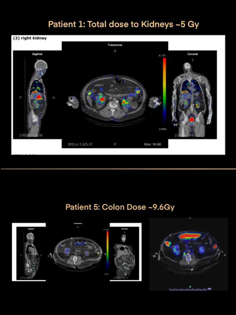 SPECT/CT valuable after radiopharmaceutical therapy | AuntMinnie