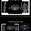 Top image displays a patient assessed for acute renal failure following third Lutathera administration where 3D dosimetry showed an average-per-administration kidney absorbed dose of 5 Gray, with total course of therapy being well under toxicity limits. Bottom image displays a patient’s absorbed dose to the colon after his first dose of Pluvicto where 3D dosimetry was used to confirm transient bowel obstruction leading to treatment management.
