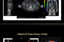 Top image displays a patient assessed for acute renal failure following third Lutathera administration where 3D dosimetry showed an average-per-administration kidney absorbed dose of 5 Gray, with total course of therapy being well under toxicity limits. Bottom image displays a patient’s absorbed dose to the colon after his first dose of Pluvicto where 3D dosimetry was used to confirm transient bowel obstruction leading to treatment management.