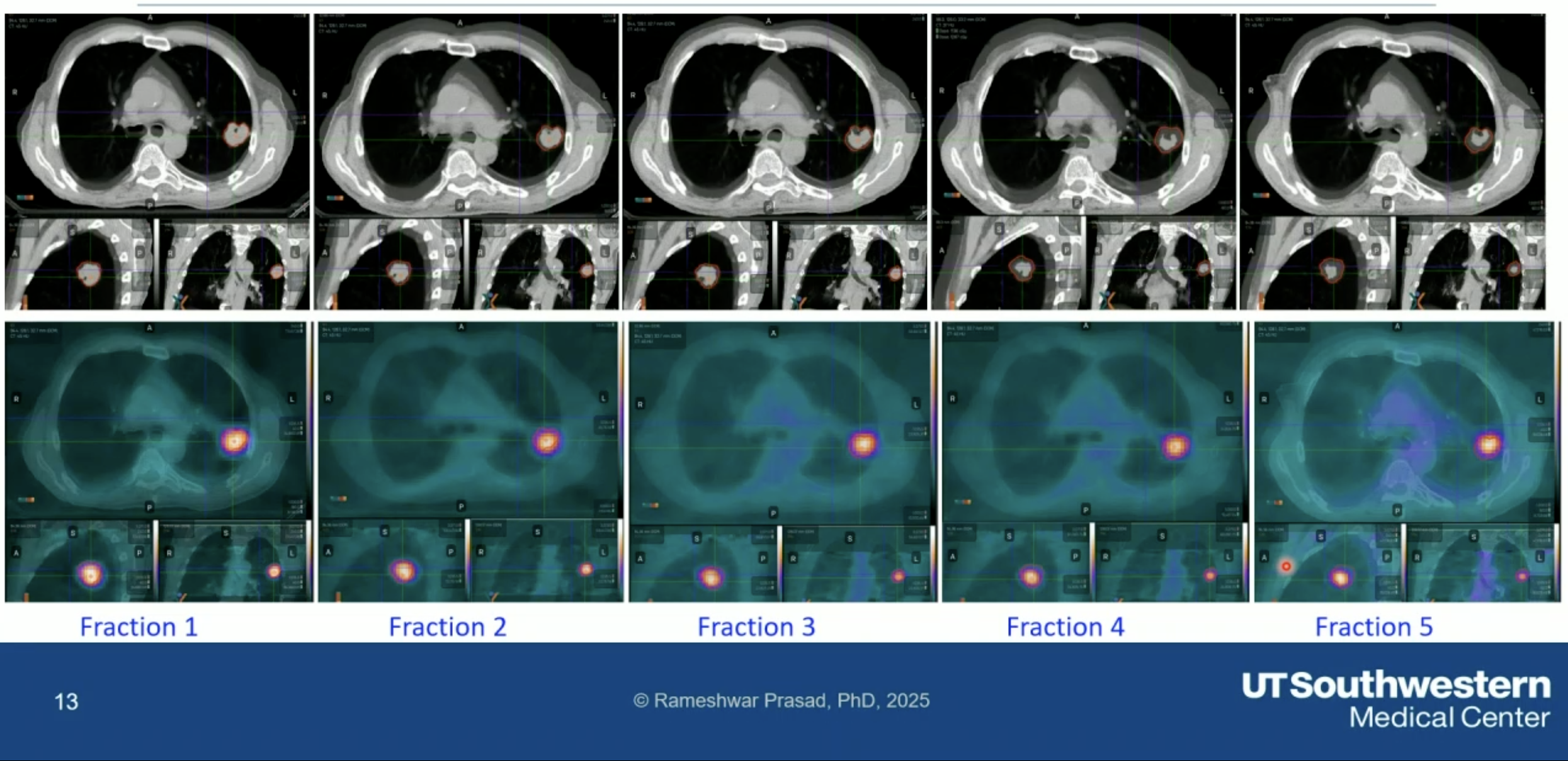 Tumor changes observed at each fraction in the adaptive system.
