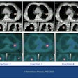 Tumor changes observed at each fraction in the adaptive system.