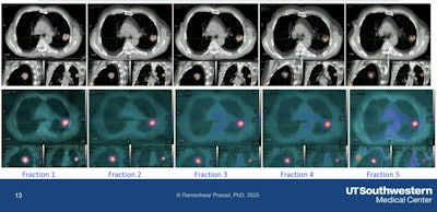Tumor changes observed at each fraction in the adaptive system.