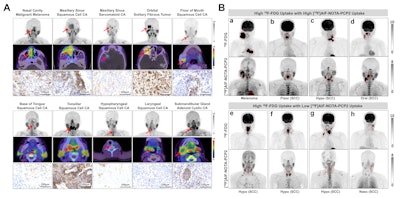 PD-L1-targeting molecular imaging in head and neck carcinoma: A head-to-head comparison of F-18 AlF-NOTA-PCP2-PET and F-18 FDG-PET/CT.