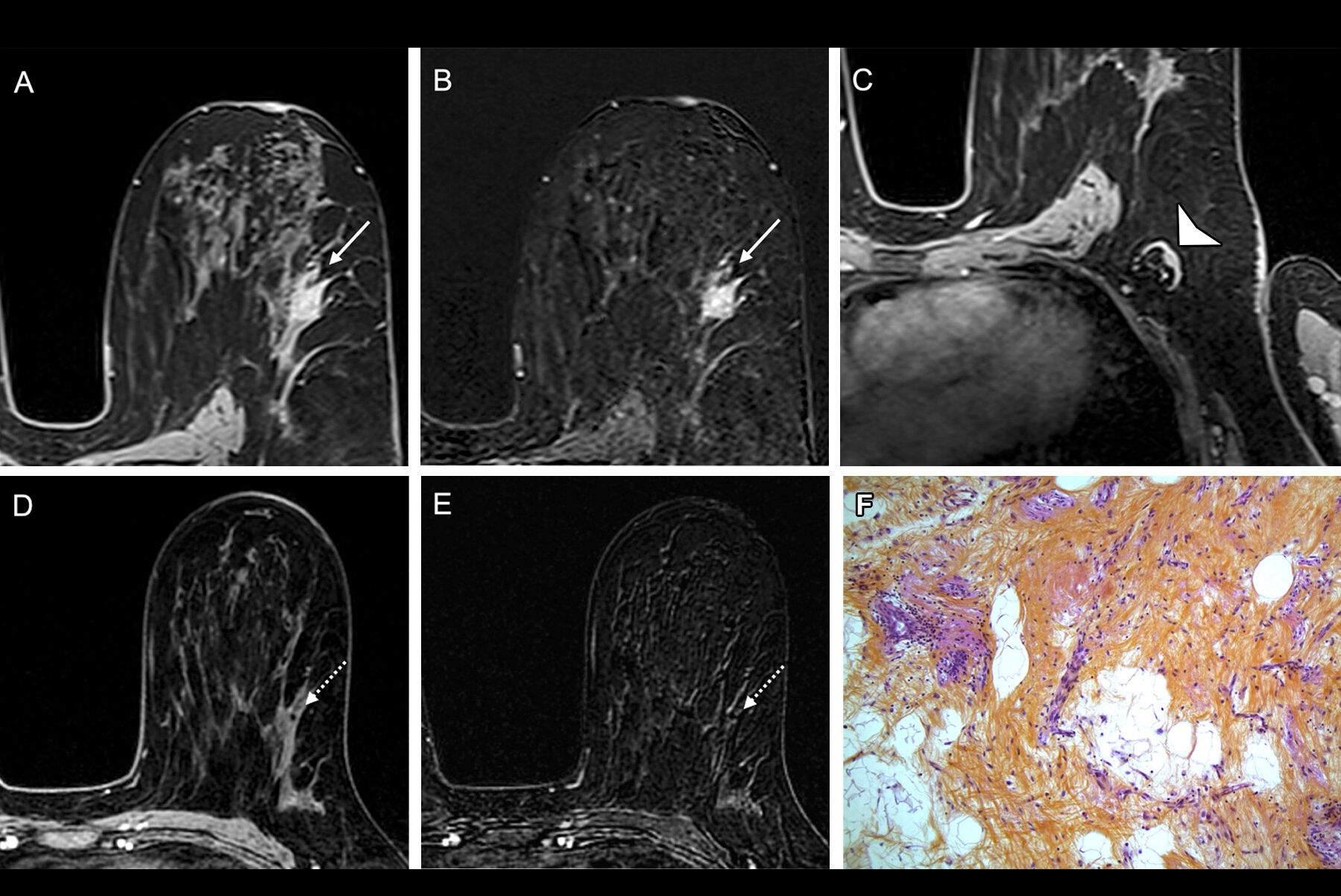 2025 07 01 Radiology Mri Breast Thumbnail