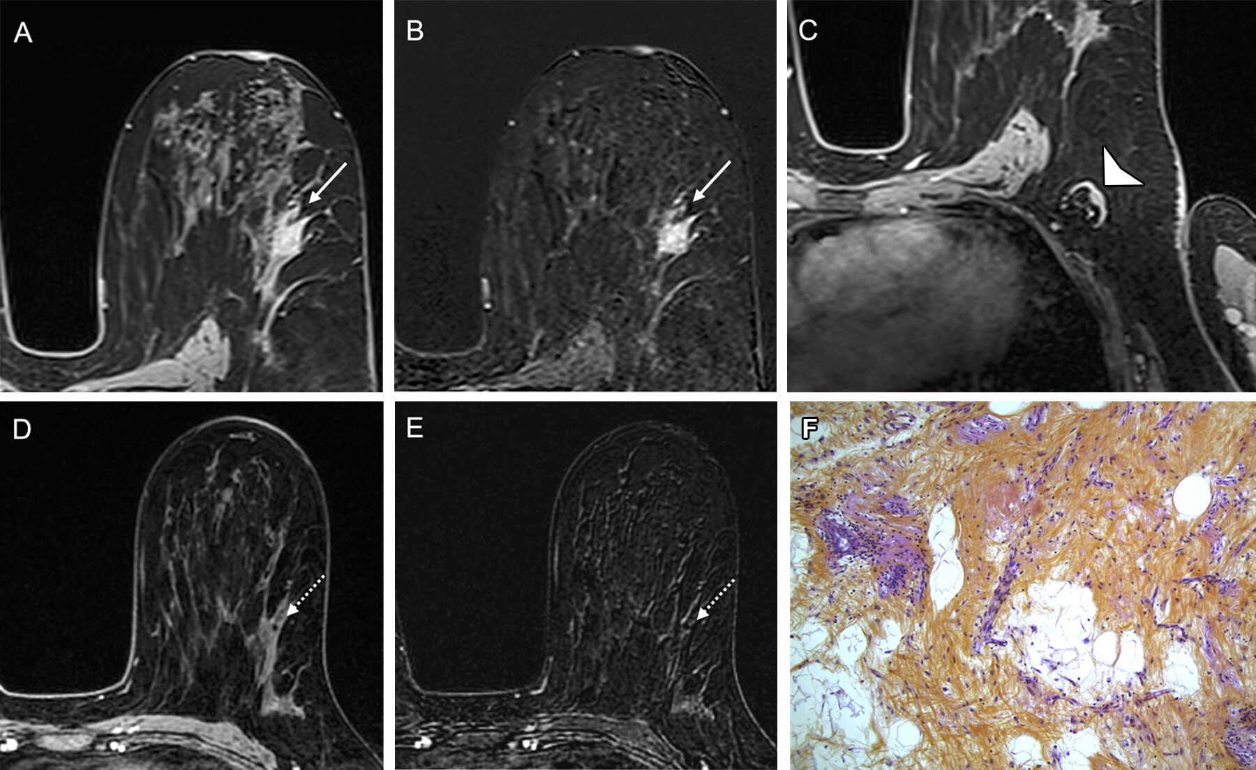 健康・医学 Breast MRI MRI model predicts treatment response for triple-negative breast