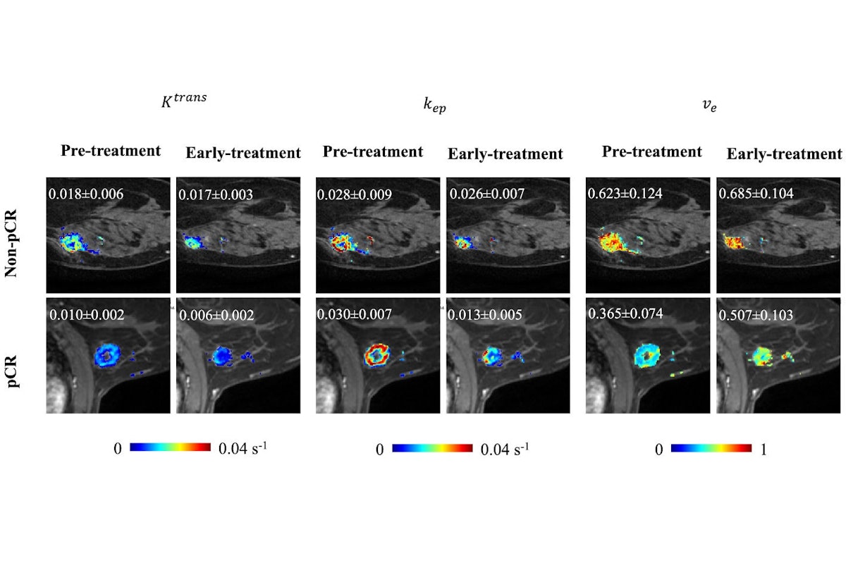Enhancing Chemo Response Prediction with Deep Learning and Breast DCE-MRI