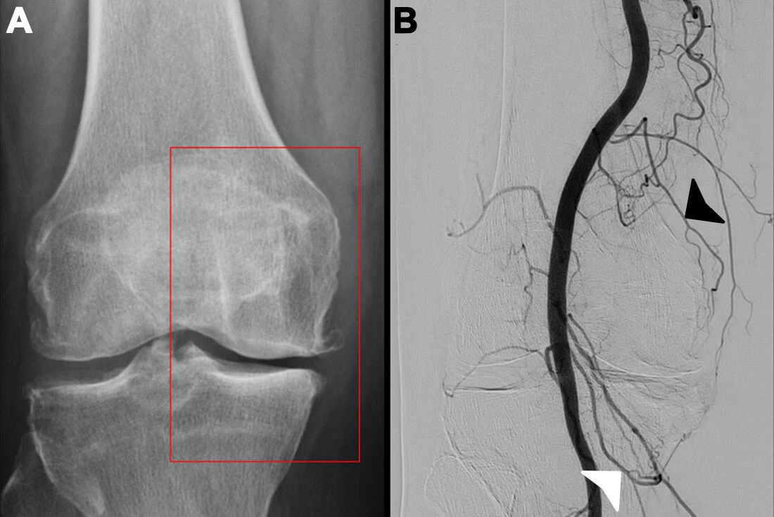 GAE further validated for patients with knee osteoarthritis GAE further validated for patients with knee osteoarthritis