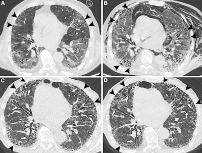 Unenhanced axial CT images show COVID-19 pneumonia in an 83-year-old male patient with preexisting interstitial lung disease (ILD). (A) Image shows ground-glass opacities in the lower lobes and in the lingula (*). Irregular reticular opacities with mild distal traction bronchiectasis are evident in the subpleural regions of both upper lobes (arrowheads), suggesting preexisting ILD with a probable usual interstitial pneumonia pattern. (B) Image obtained during hospitalization for respiratory distress shows spontaneous pneumomediastinum and diffuse chest wall subcutaneous emphysema, predominantly on the left side. The image also shows persistent, diffuse ground-glass opacities (*) and peripheral fibrotic lung changes (arrowheads). (C) Unenhanced follow-up image obtained at six months shows the progressive nature of lung fibrosis, with the development of honeycombing (arrowheads) and severe bronchiectasis (arrows), predominantly affecting the anterior peripheral regions of both lungs. (D) Unenhanced follow-up image obtained at 14 months shows the progression of honeycombing (arrowheads) and severe bronchiectasis (arrows) at the anterior peripheral regions of both lungs. In this case, SARS-CoV-2 infection likely acted as a trigger for the exacerbation of previously undiagnosed fibrotic ILD, with mechanical ventilation potentially contributing to extensive fibrosis in the anterior lung regions (arrowheads). The patient was administered antifibrotic therapy after the resolution of the acute phase.