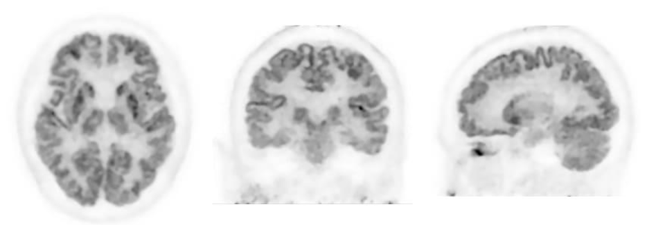 Three FDG-PET scans acquired on PositView SET-5002 showing horizontal, coronal, and sagittal cross-sections.