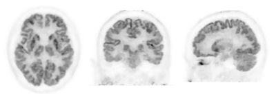 Three FDG-PET scans acquired on PositView SET-5002 showing horizontal, coronal, and sagittal cross-sections.