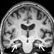 Ad Mri