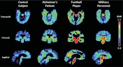 F-18 Flornaptitril binds with both tau aggregates and beta-amyloid plaque to enhance PET scan imaging of these pathological proteins in the brain.