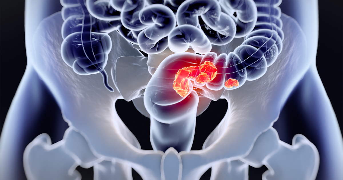 Colorectal Cancer Social (2)