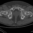 Ct Hip Radiograph Thumbnail