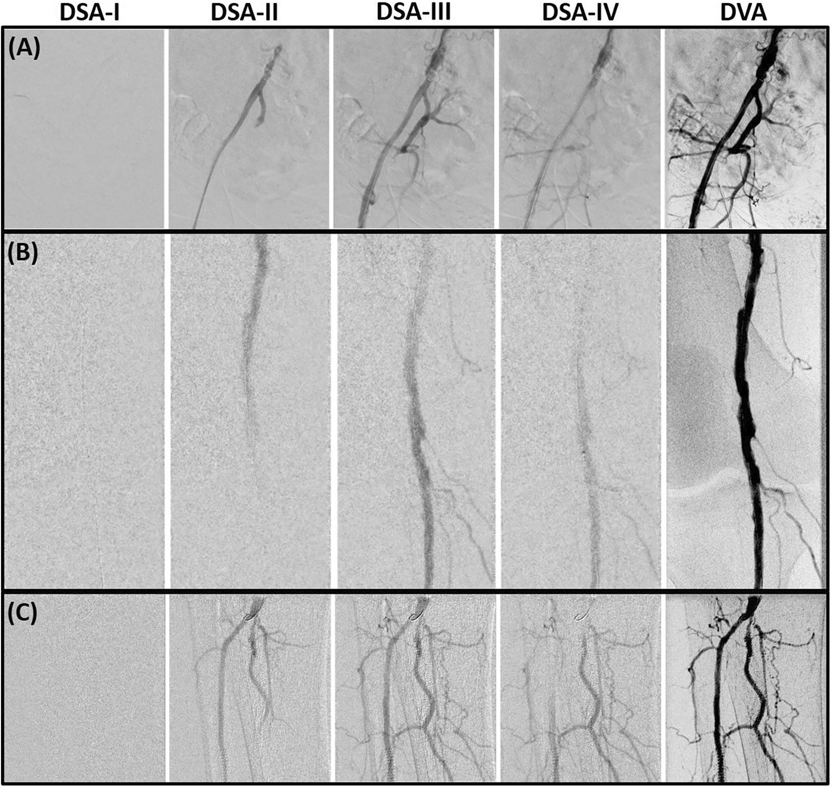 Pelvic (A), femoral and popliteal (B), and cruro-pedal (C) region. The summated digital variance angiography (DVA) image significantly enhances image quality compared to the digital subtraction angiography (DSA) series I&ndash;IV (depicting 4 out of 28 (A), 48 (B) and 28 (C) DSA images) of the low dose (LD) acquisitions. Enhancements of iodinated contrast medium (ICM) by DVA depict small vessel structures in detail while the conventional DSA offers a reduced contrast-to-noise ratio (CNR) using LD acquisitions for standalone diagnostic interpretations.