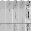 Pelvic (A), femoral and popliteal (B), and cruro-pedal (C) region. The summated digital variance angiography (DVA) image significantly enhances image quality compared to the digital subtraction angiography (DSA) series I–IV (depicting 4 out of 28 (A), 48 (B) and 28 (C) DSA images) of the low dose (LD) acquisitions. Enhancements of iodinated contrast medium (ICM) by DVA depict small vessel structures in detail while the conventional DSA offers a reduced contrast-to-noise ratio (CNR) using LD acquisitions for standalone diagnostic interpretations.