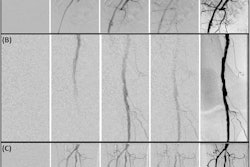 Pelvic (A), femoral and popliteal (B), and cruro-pedal (C) region. The summated digital variance angiography (DVA) image significantly enhances image quality compared to the digital subtraction angiography (DSA) series I–IV (depicting 4 out of 28 (A), 48 (B) and 28 (C) DSA images) of the low dose (LD) acquisitions. Enhancements of iodinated contrast medium (ICM) by DVA depict small vessel structures in detail while the conventional DSA offers a reduced contrast-to-noise ratio (CNR) using LD acquisitions for standalone diagnostic interpretations.