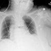Plain chest radiograph showing overlay from Critical Care Suite, with segmentation of ETT, identification of tube tip and carina, and calculation of distance between them.