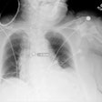 Plain chest radiograph showing overlay from Critical Care Suite, with segmentation of ETT, identification of tube tip and carina, and calculation of distance between them.